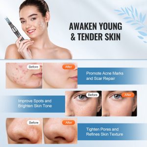 VEVOR Professional Microneedling Pen 6-Speed Electric Beauty Pen with 22 Needles - Image 6